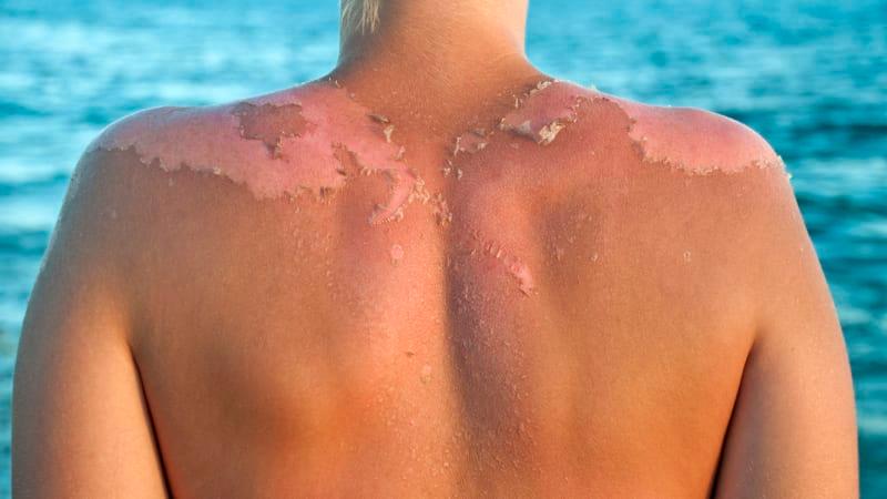 Jak se starat o pokožku po spálení sluncem: Rychlá úleva a obnova